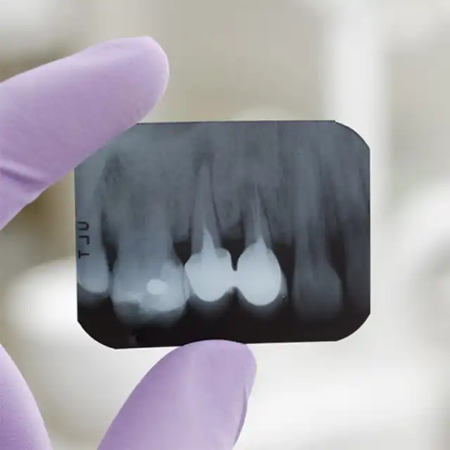 RX-Periapical